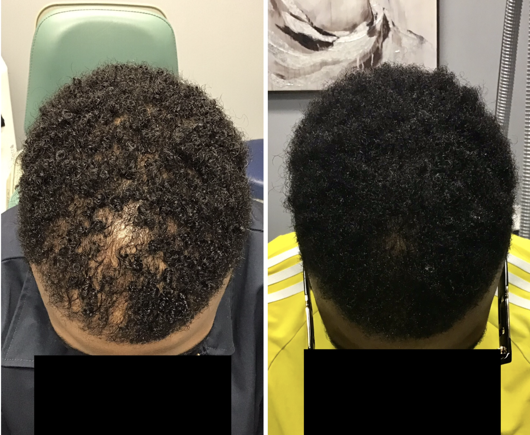 Crown Thinning Treatment