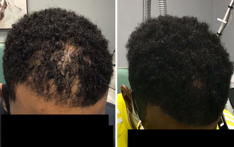 Textured Hair Restoration