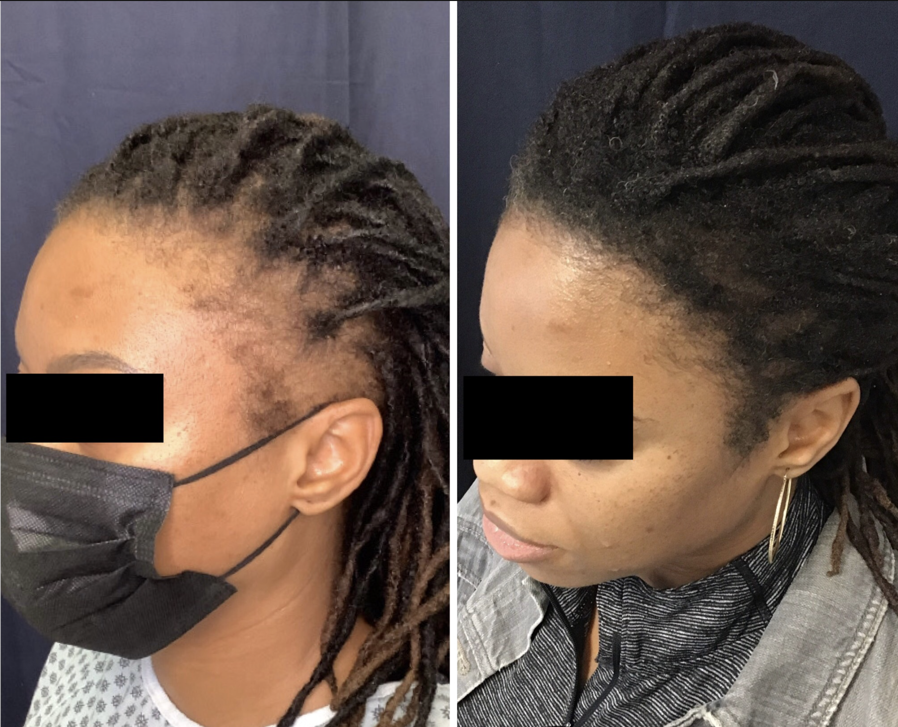 Female Hair Loss Treatments