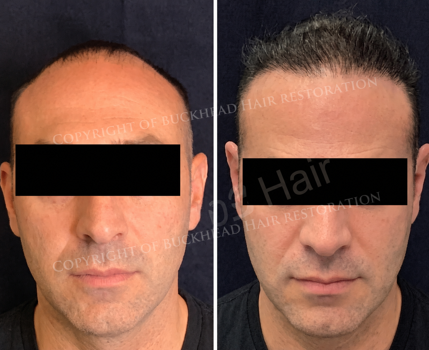Comprehensive Frontal Restoration