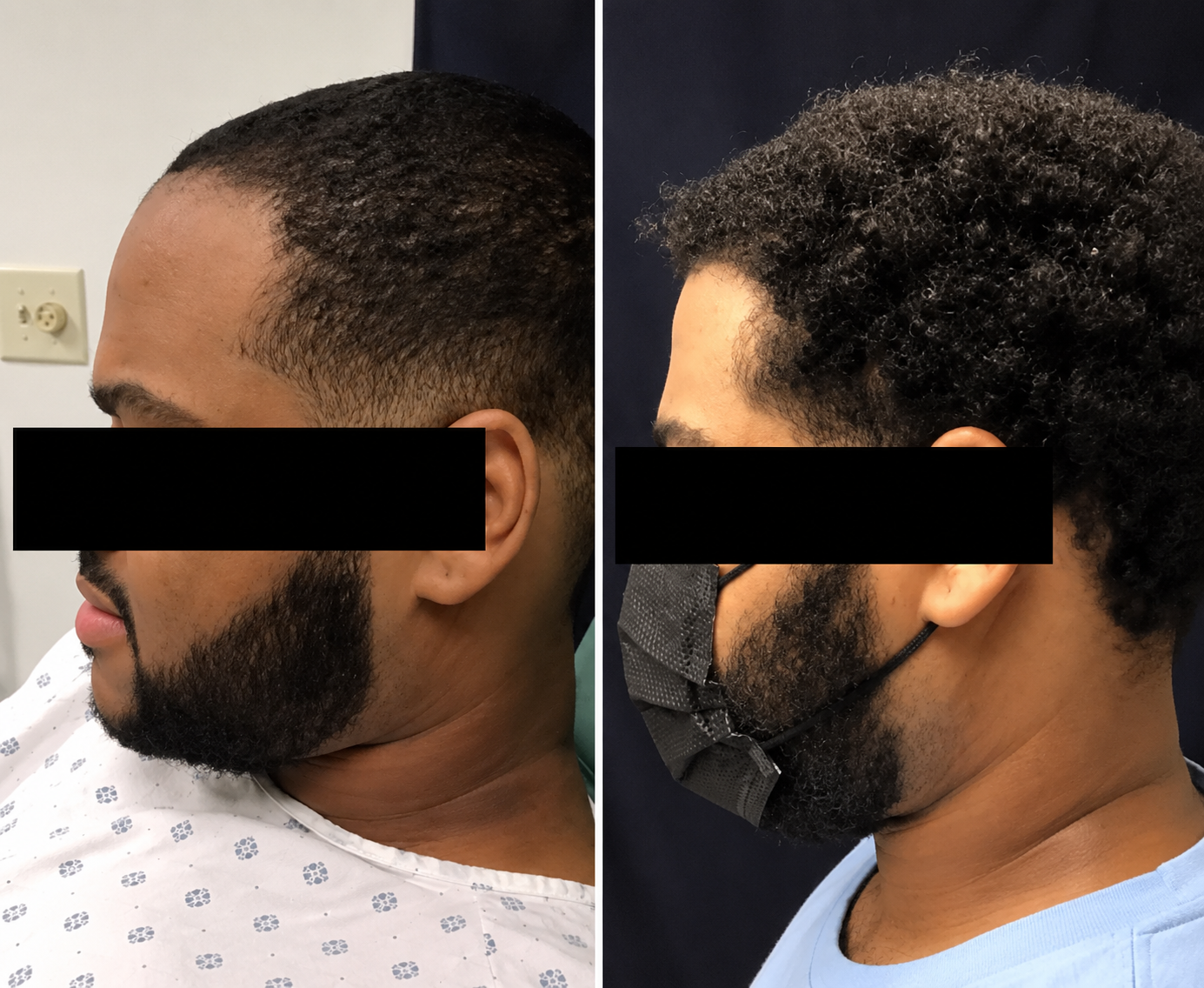 Male Frontal & Temple Hairline Restoration
