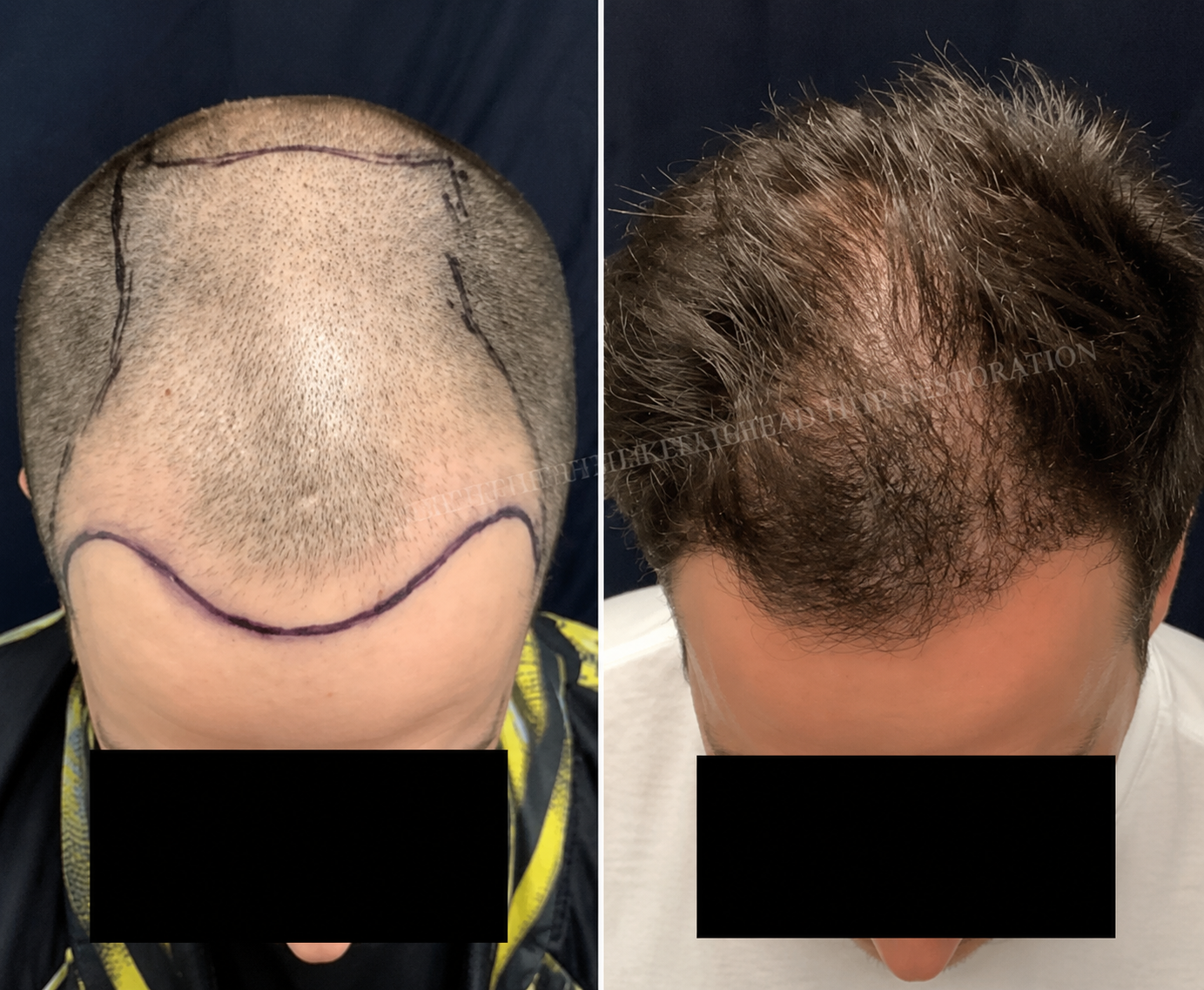 Extensive Frontal & Mid-Scalp Restoration