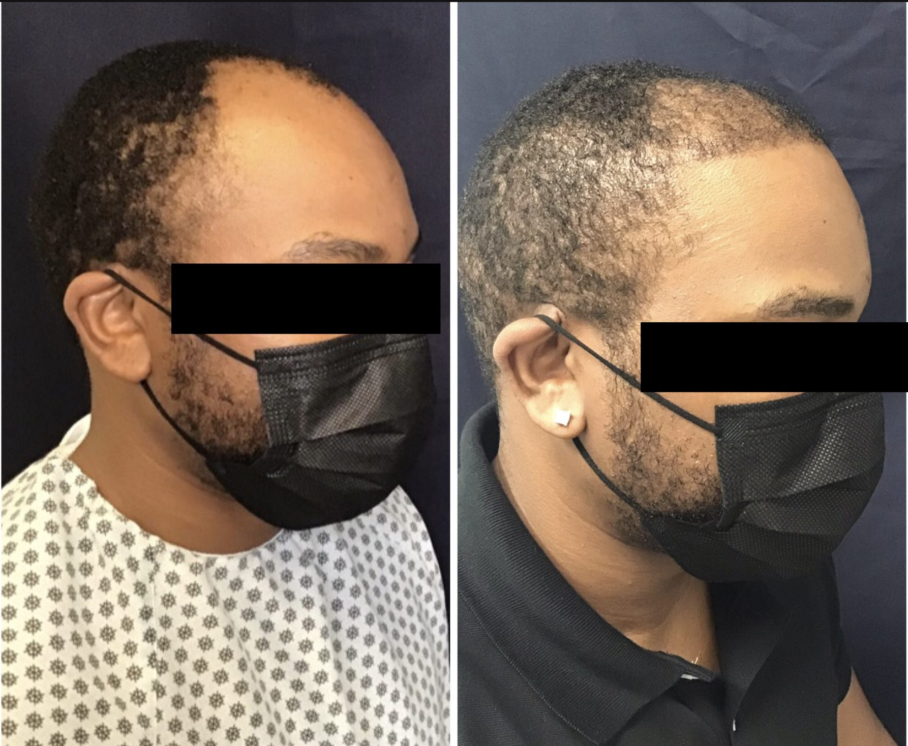 Male Hairline & Frontal Restoration