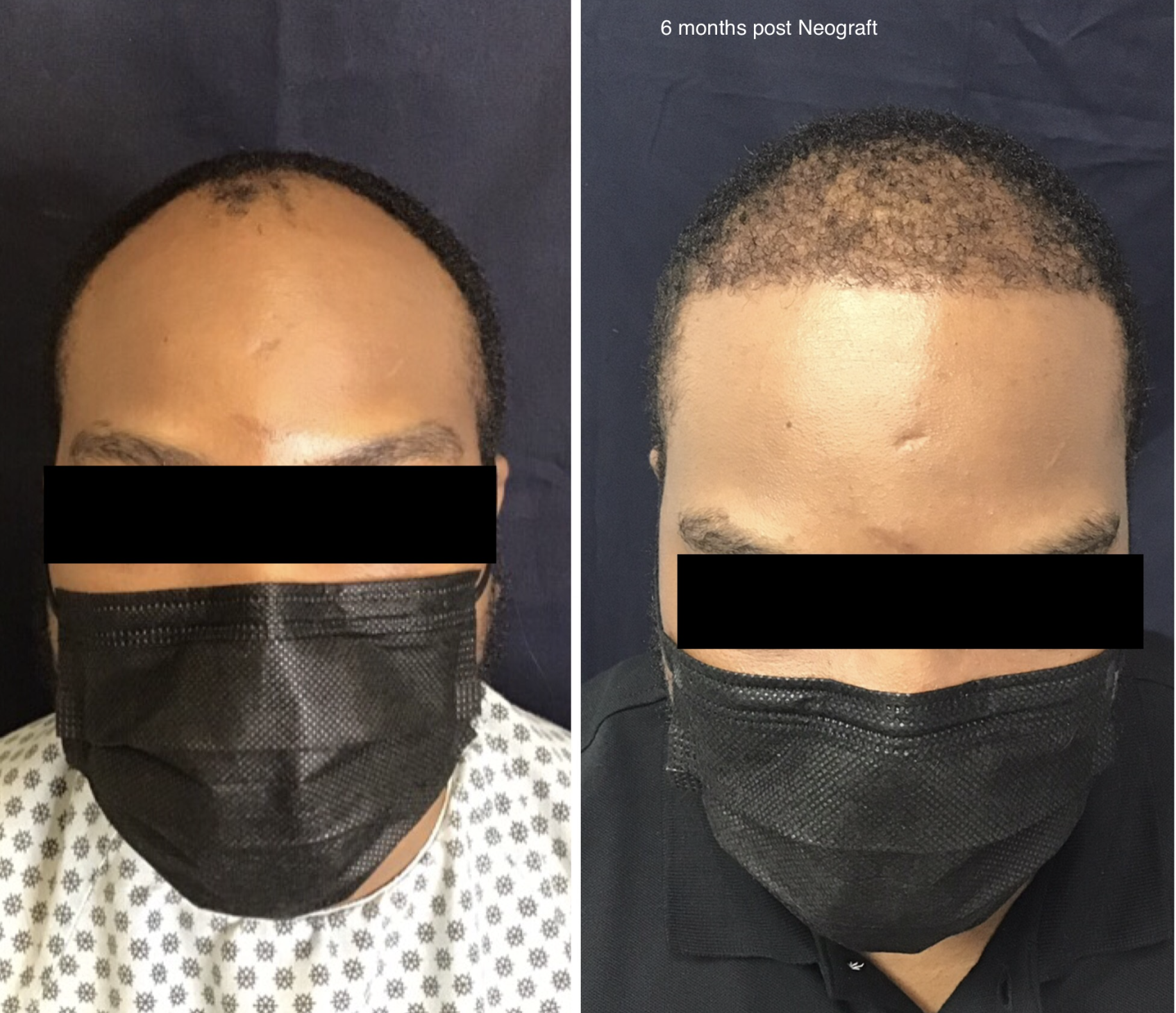Advanced Hairline Advancement
