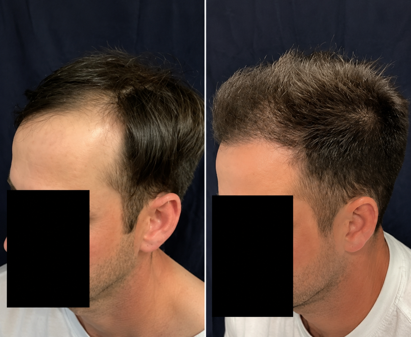 Male Frontal Hairline Restoration
