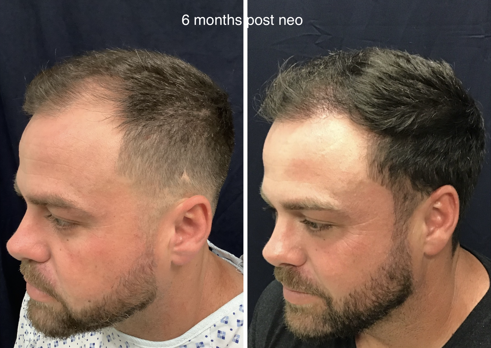 Frontal Hairline Reconstruction