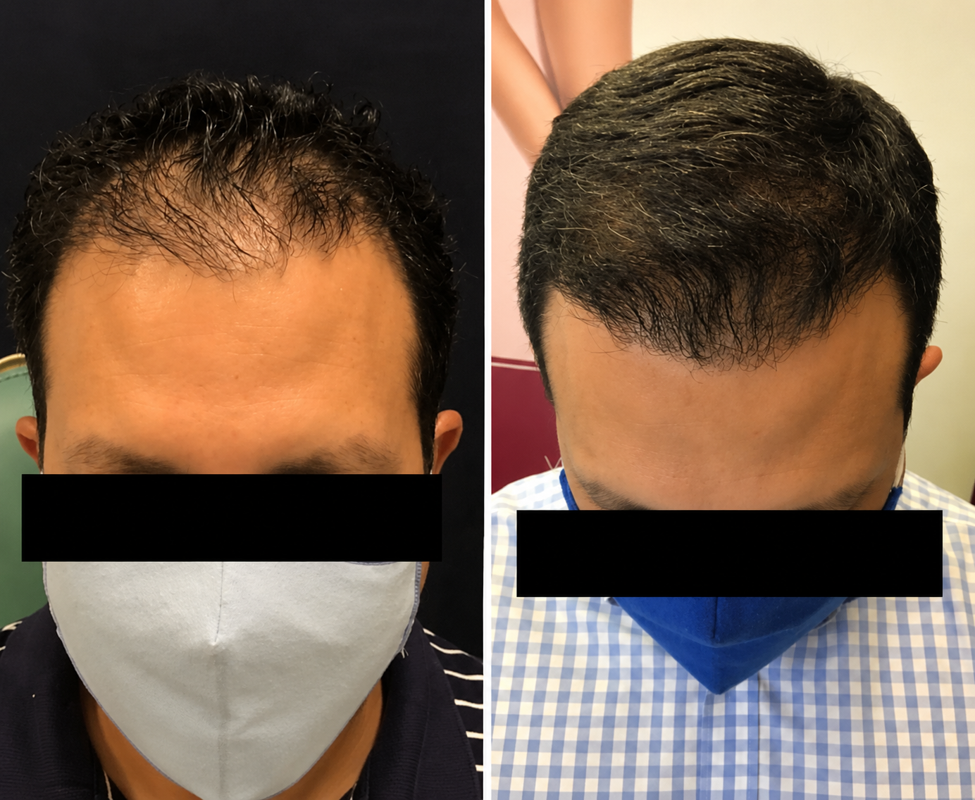 Frontal Hairline Density Improvement