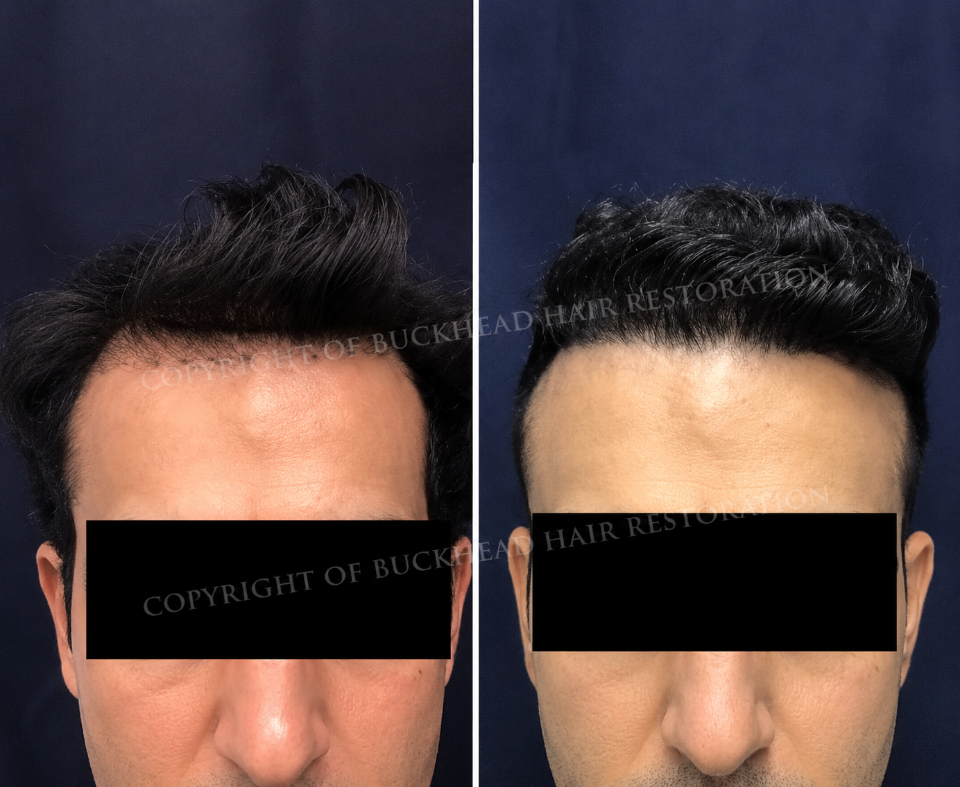 Male Frontal Hairline Density Restoration