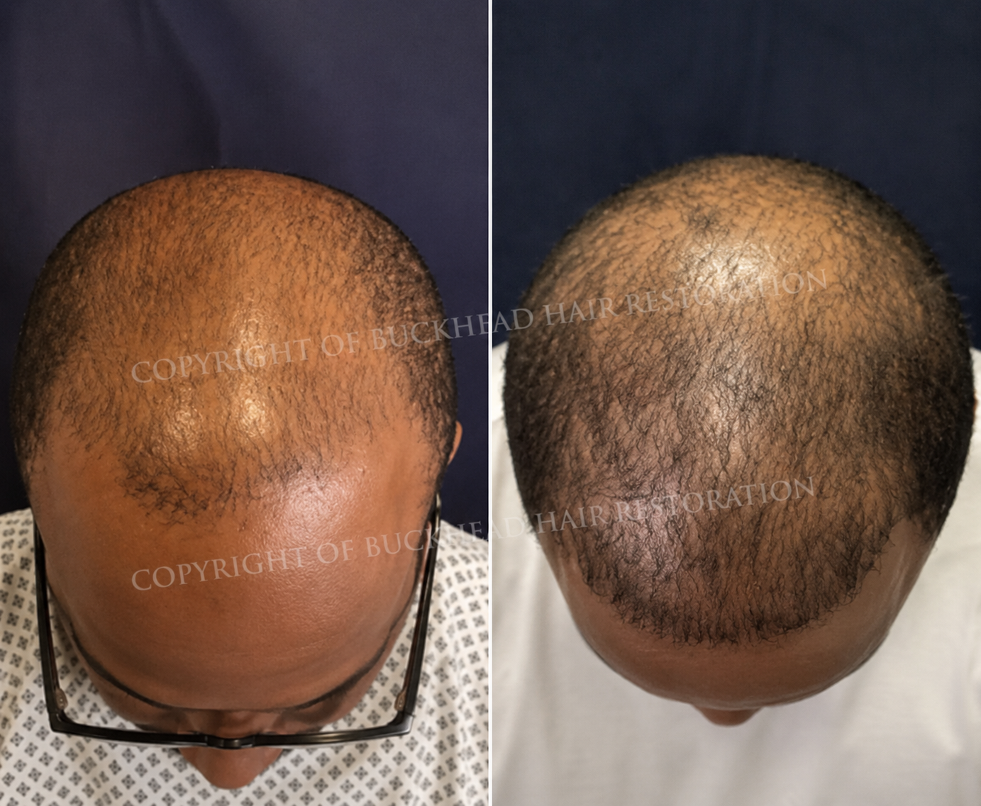 Extensive Crown and Mid-Scalp Restoration