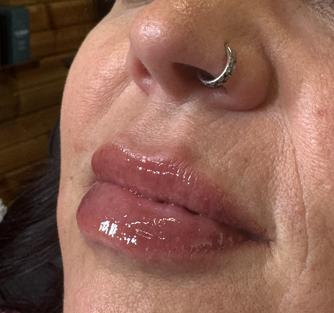 After Lip Hydration at D'Vinely You Aesthetics