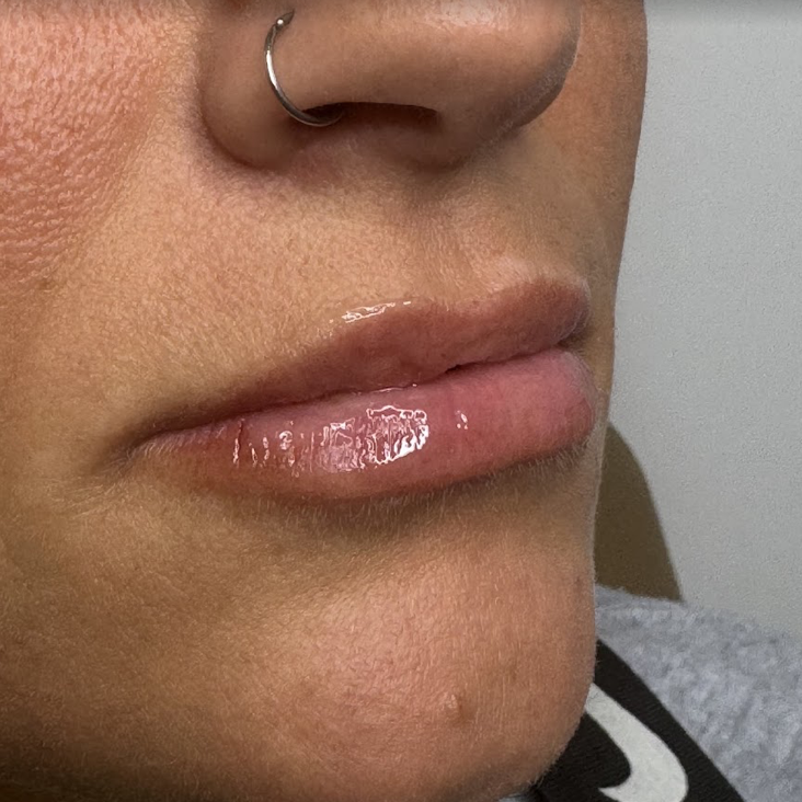 Lip filler before and after results at D'Vinely You Aesthetics