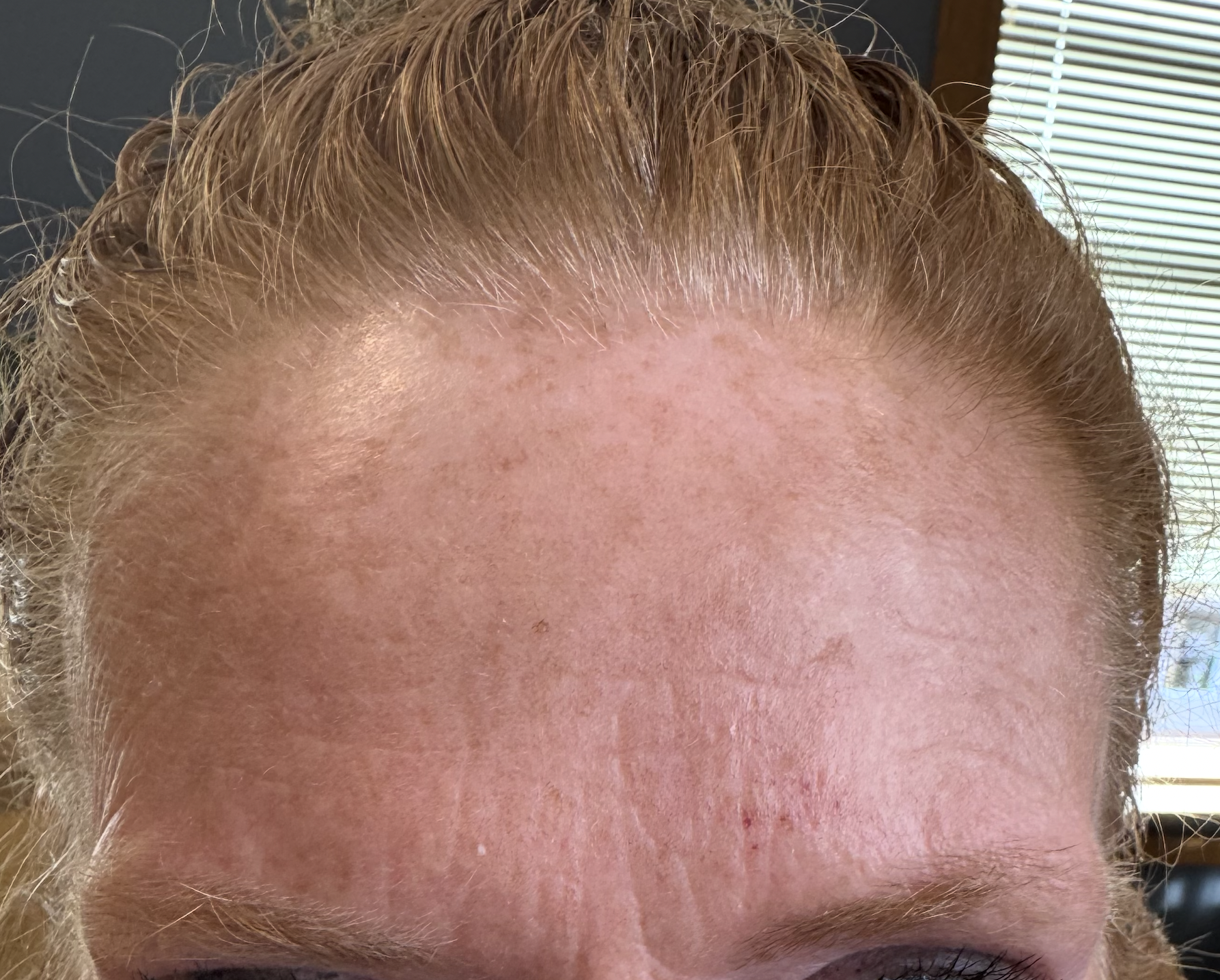 After Toxin at D'Vinely You Aesthetics
