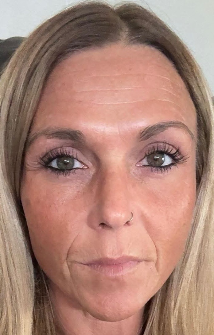 Neurotoxins at D'Vinely You Aesthetics
