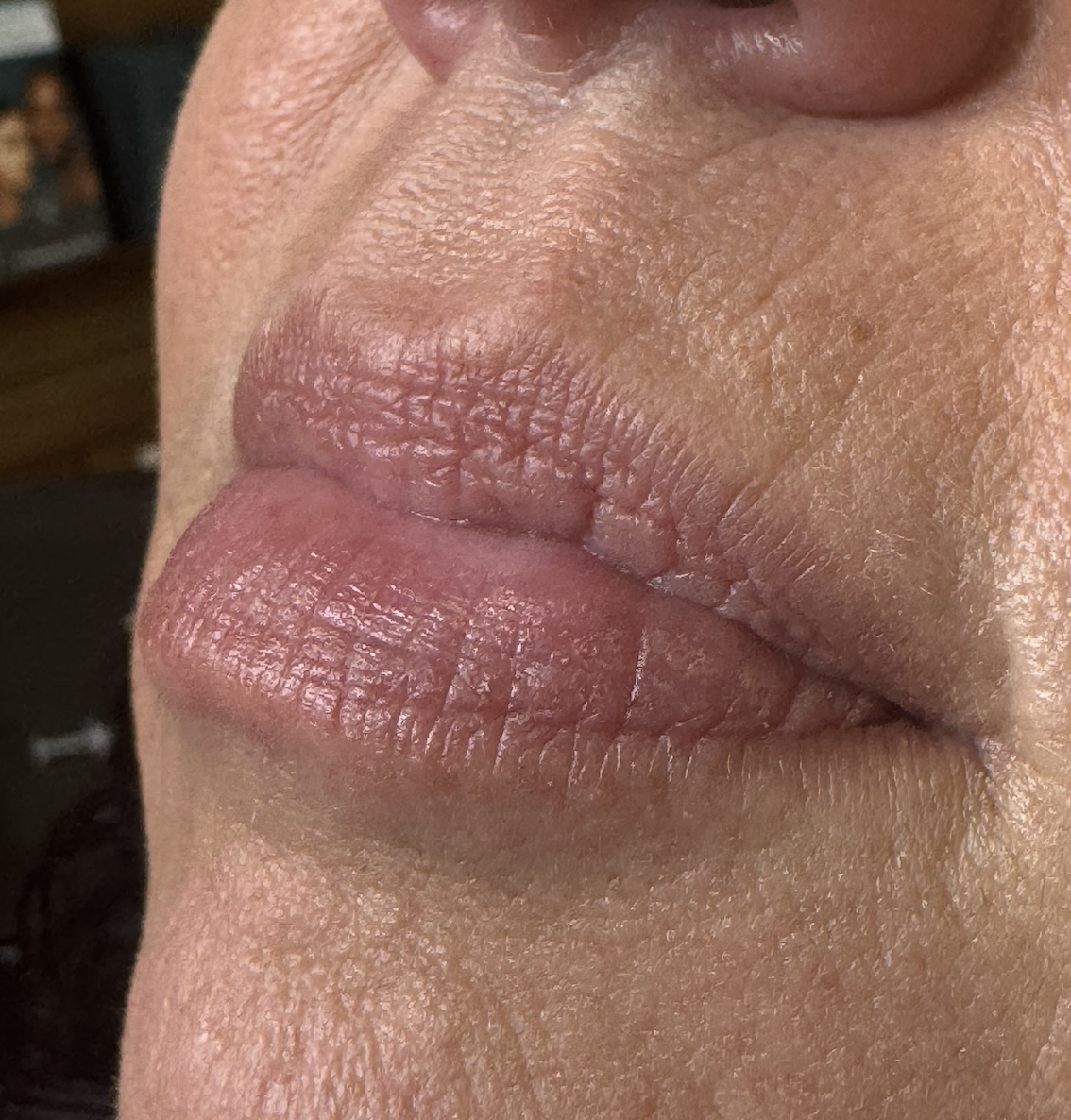 Before Lip Hydration at D'Vinely You Aesthetics