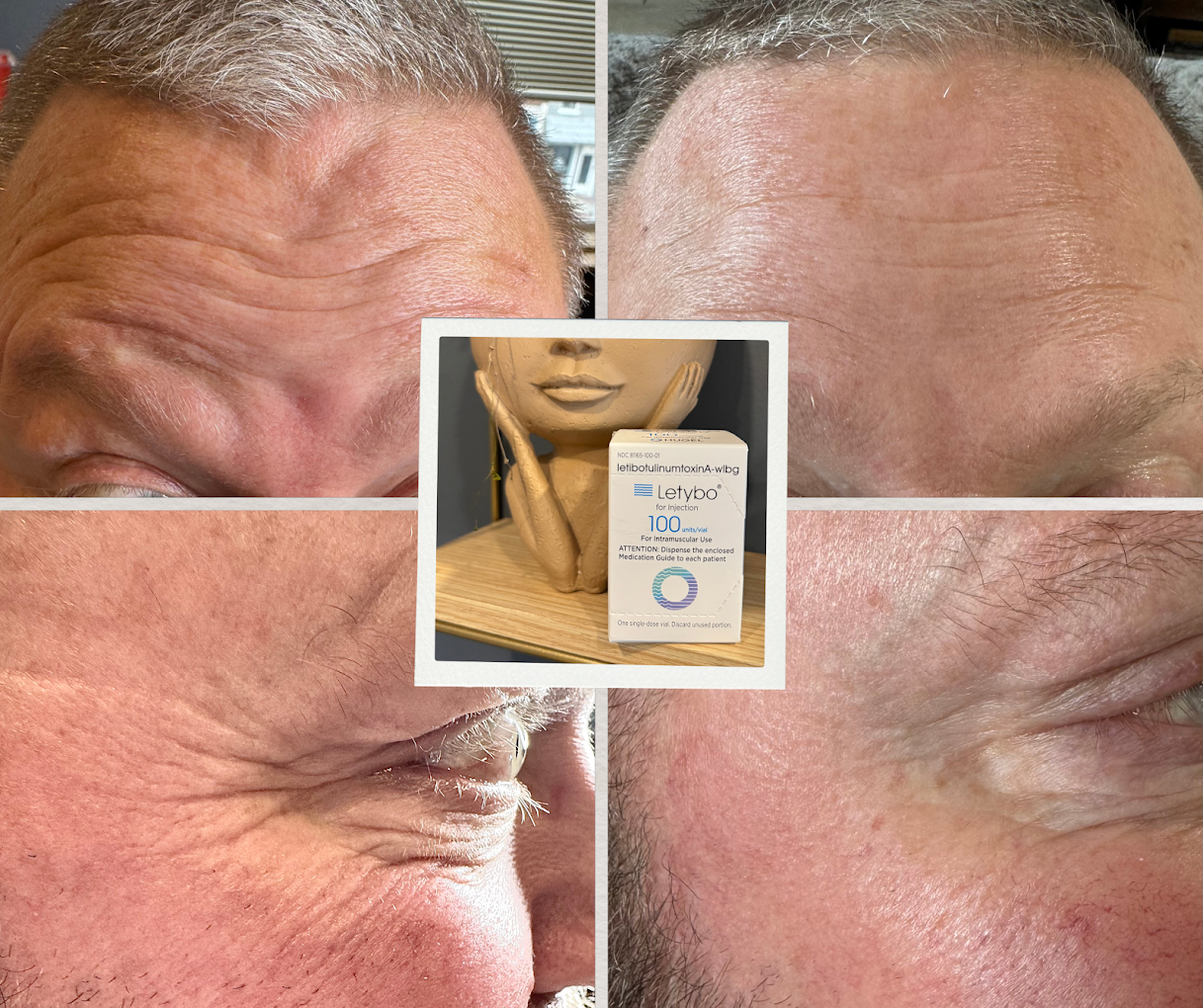Botox forehead before and after results at D'Vinely You Aesthetics