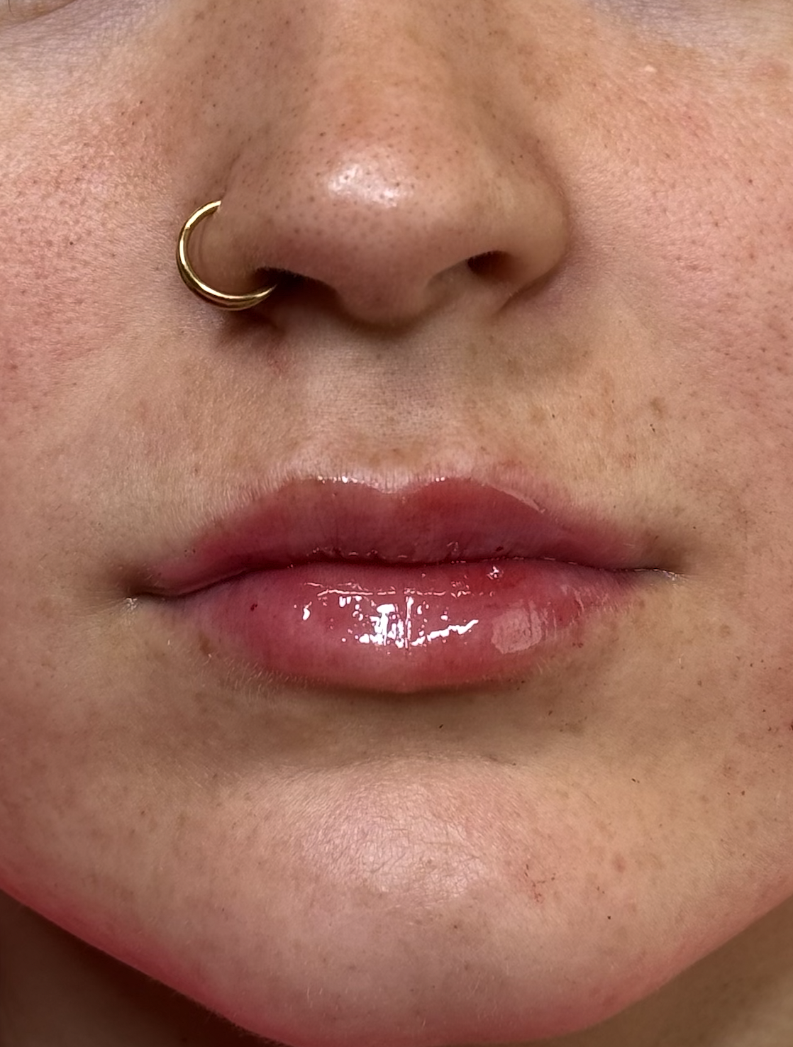 Lip Filler at D'Vinely You Aesthetics