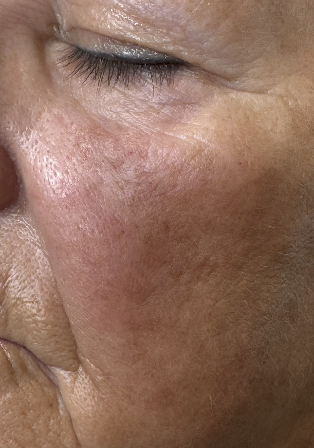 After Cheek Filler at D'Vinely You Aesthetics