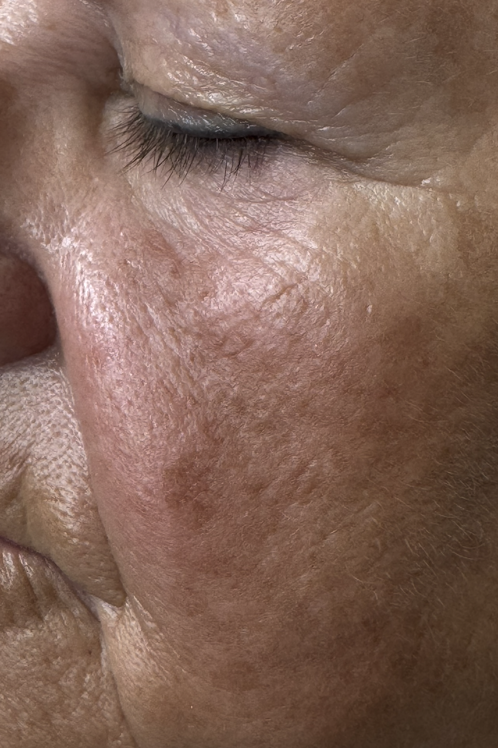 Before Cheek Filler at D'Vinely You Aesthetics