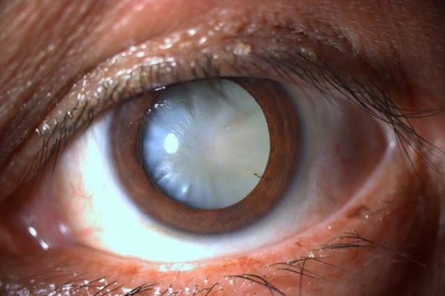 Degeneración macular: diferencias entre la forma seca y húmeda y opciones de tratamiento