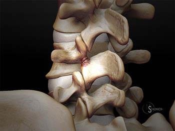 Pars fractures in the spine