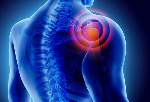 Anatomy of a shoulder joint showing inflammation and pain highlighted in frozen shoulder