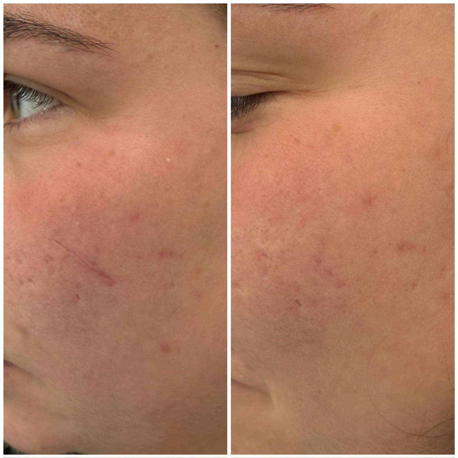 Acne Scarring before and after — Acne & scarring improvement · Before & After