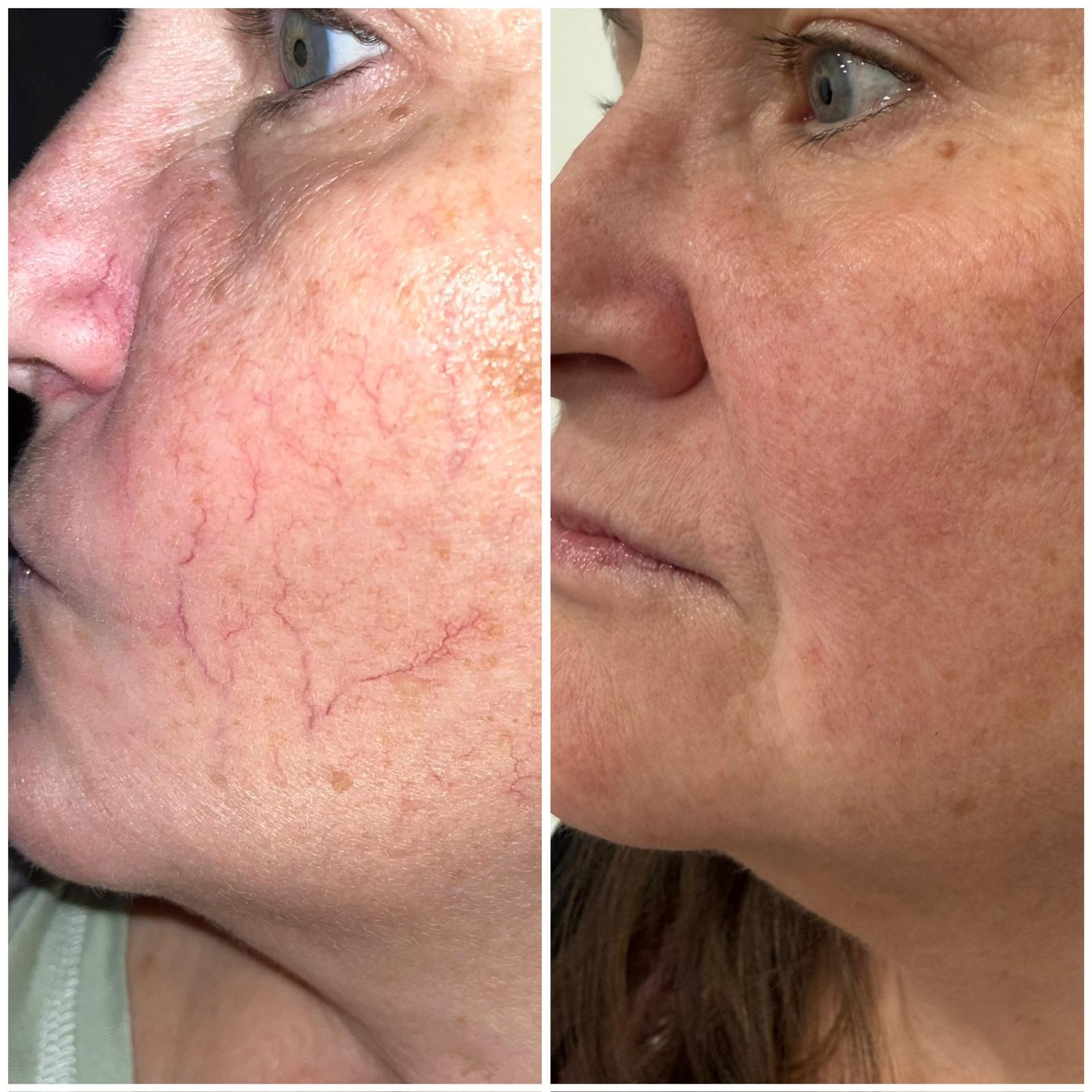 Before and after vascular laser treatment for facial broken capillaries