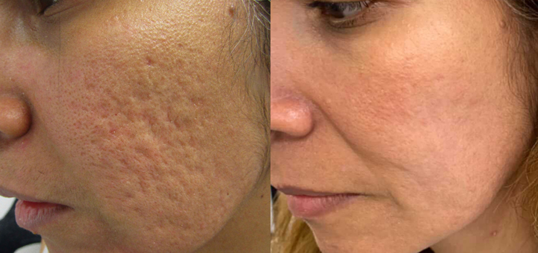 Acne Scarring before and after — Post-acne scarring · RF microneedling series