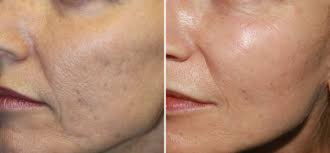 Texture before and after — Uneven texture & enlarged pores · 4 sessions