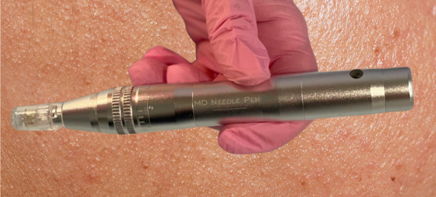 Nano needling and microneedling pen in-clinic at The Skin Edit