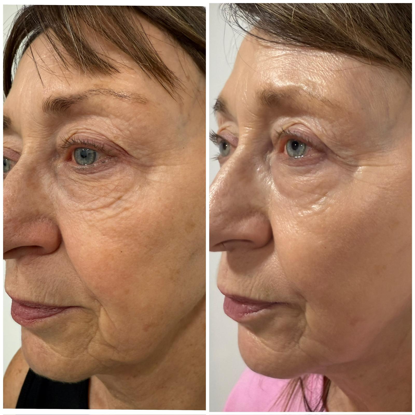Texture before and after — Skin texture refinement · Before & After