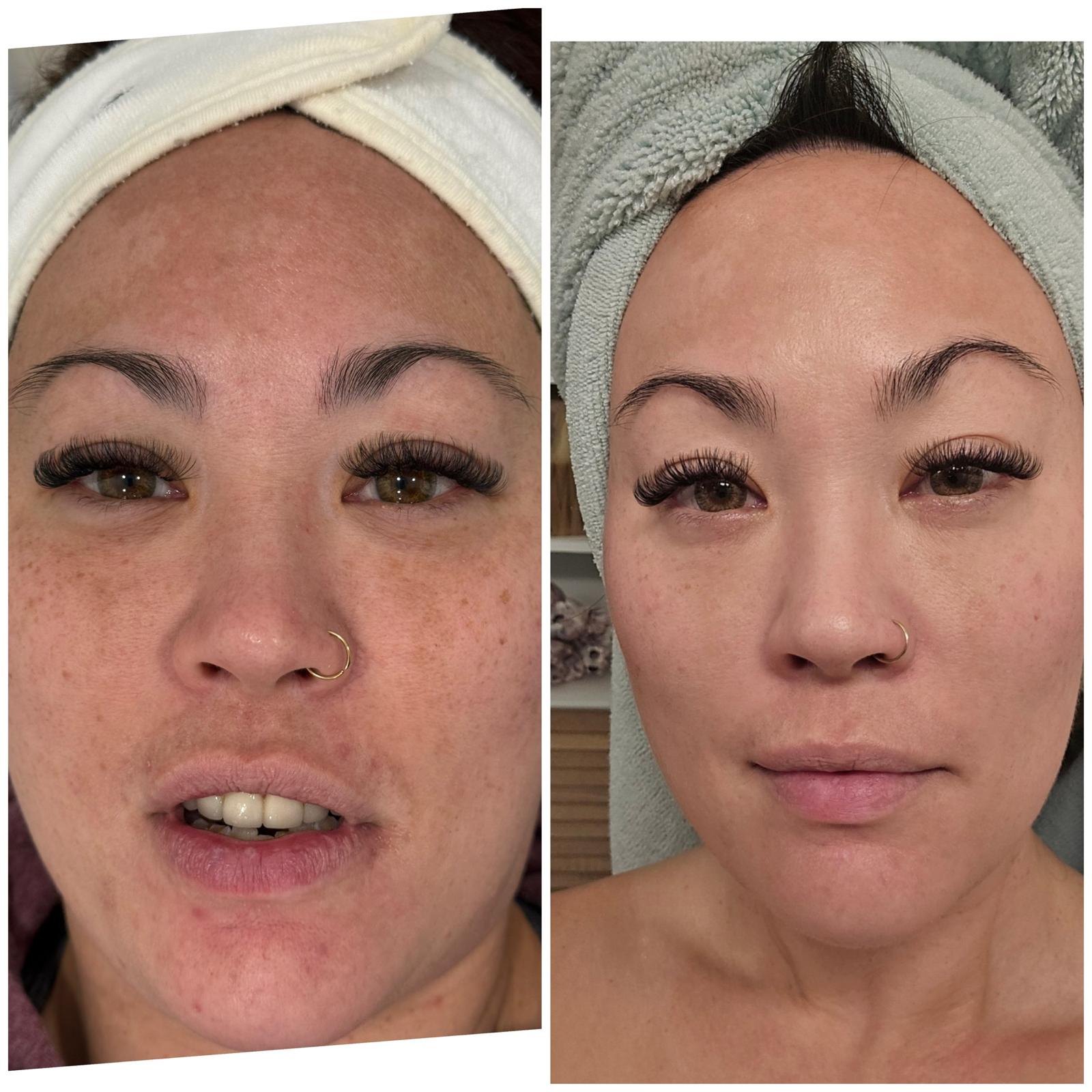 Texture before and after — Pigmentation correction · Before & After