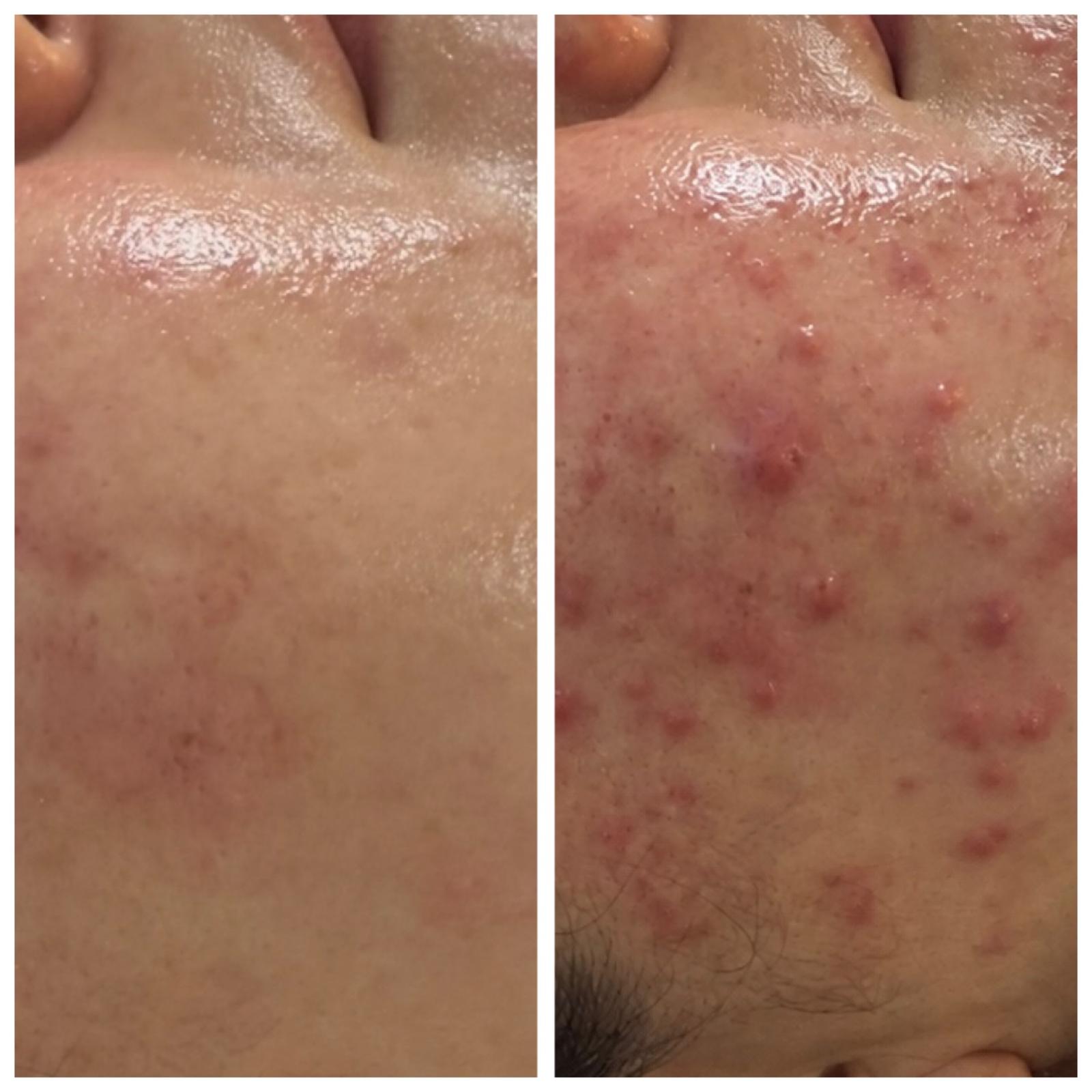 Acne Scarring before and after — Acne scarring correction · Before & After