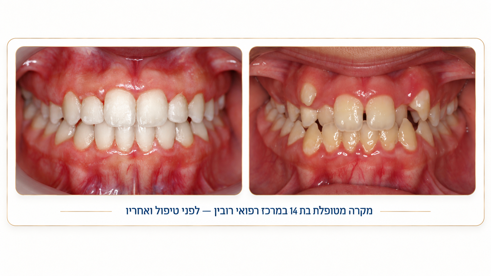 יישור שיניים לפני ואחרי 5 — מקרה מטופל במרכז רפואי רובין