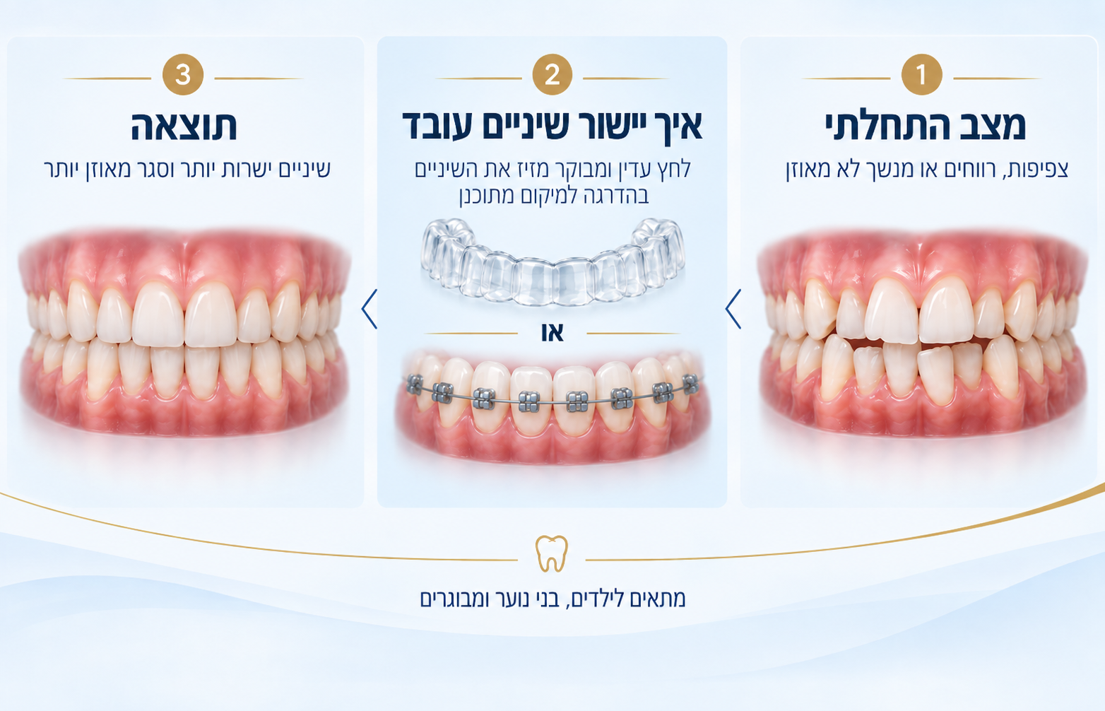 איך עובד יישור שיניים באמצעות קשתיות שקופות או סמכים קבועים