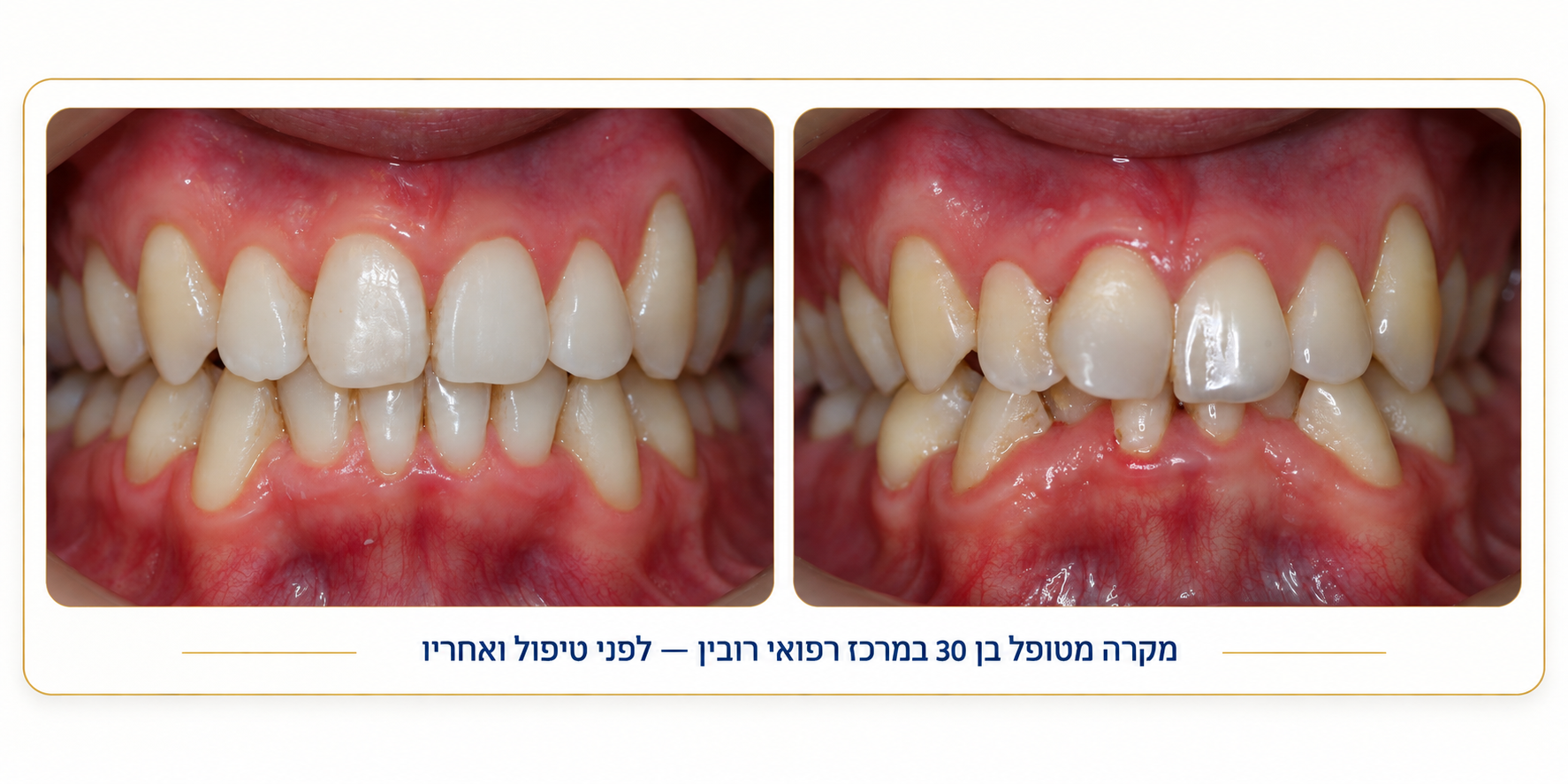 יישור שיניים לפני ואחרי 6 — מקרה מטופל במרכז רפואי רובין