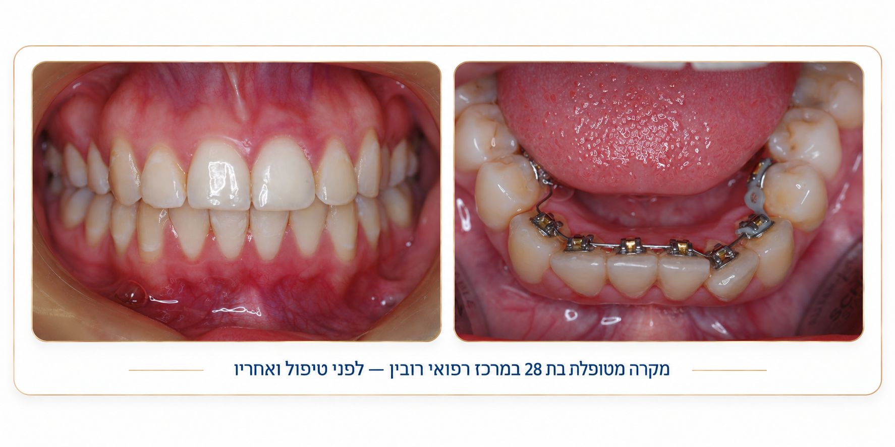 יישור שיניים לפני ואחרי 2 — מקרה מטופל במרכז רפואי רובין