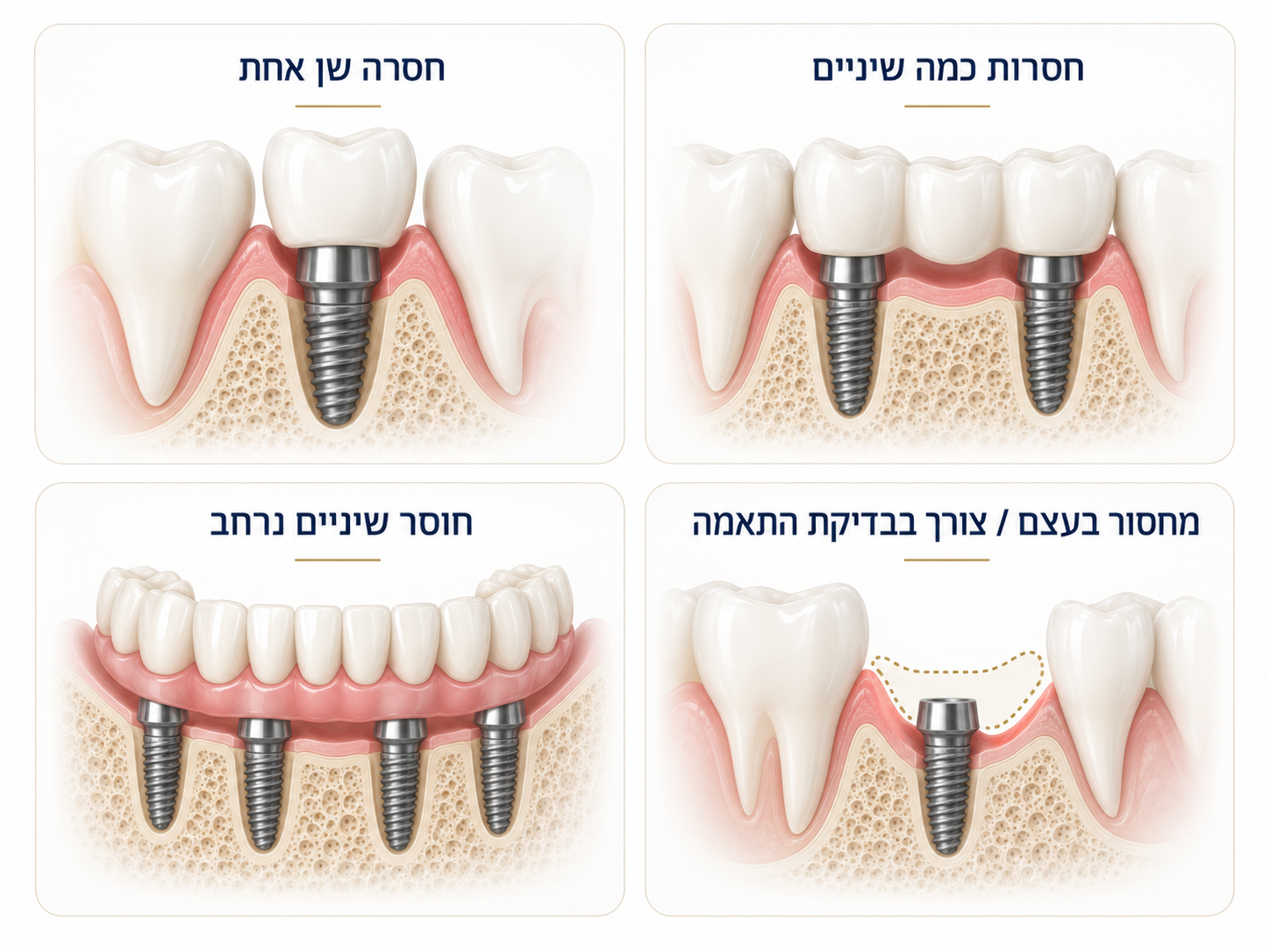 אפשרויות שיקום בהשתלות שיניים לפי מספר השיניים החסרות ומצב העצם