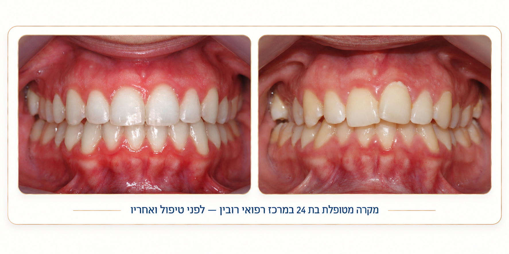 יישור שיניים לפני ואחרי 1 — מקרה מטופל במרכז רפואי רובין