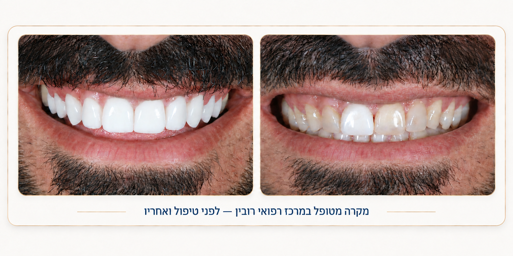 ציפוי שיניים חרסינה לפני ואחרי – תיקון גוון שן בודדת ויישור קו חיוך מושלם