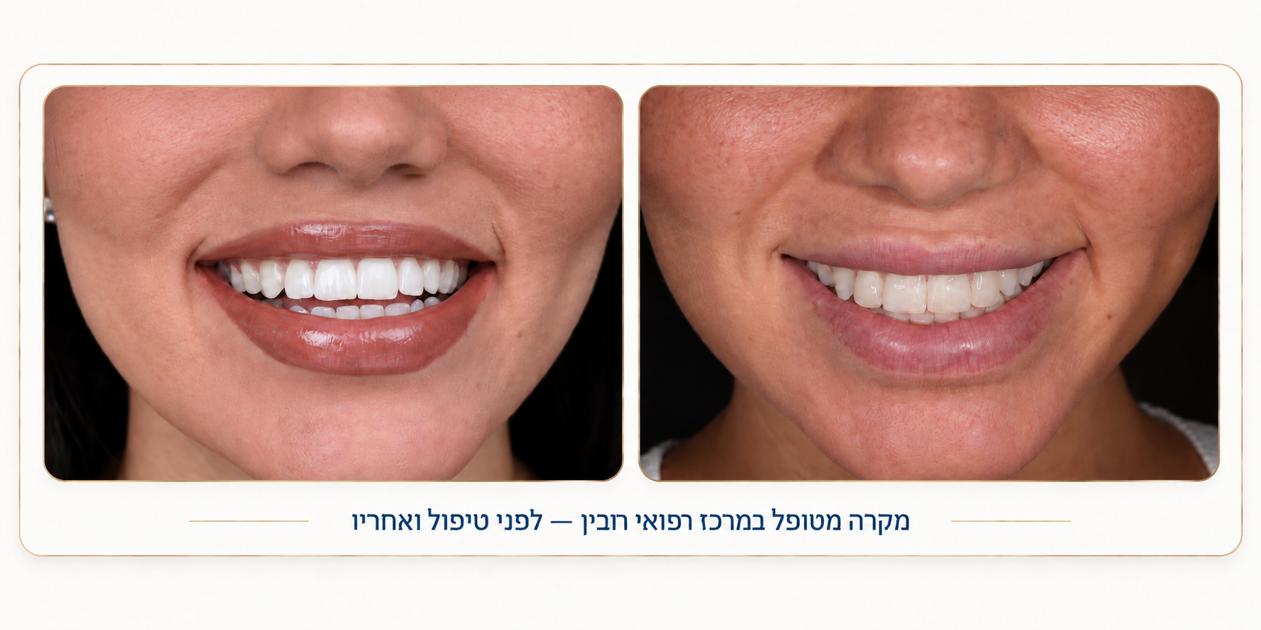 ציפוי שיניים ללא שיוף והכנה מינימלית לפני ואחרי – עיצוב חיוך טבעי ומושלם