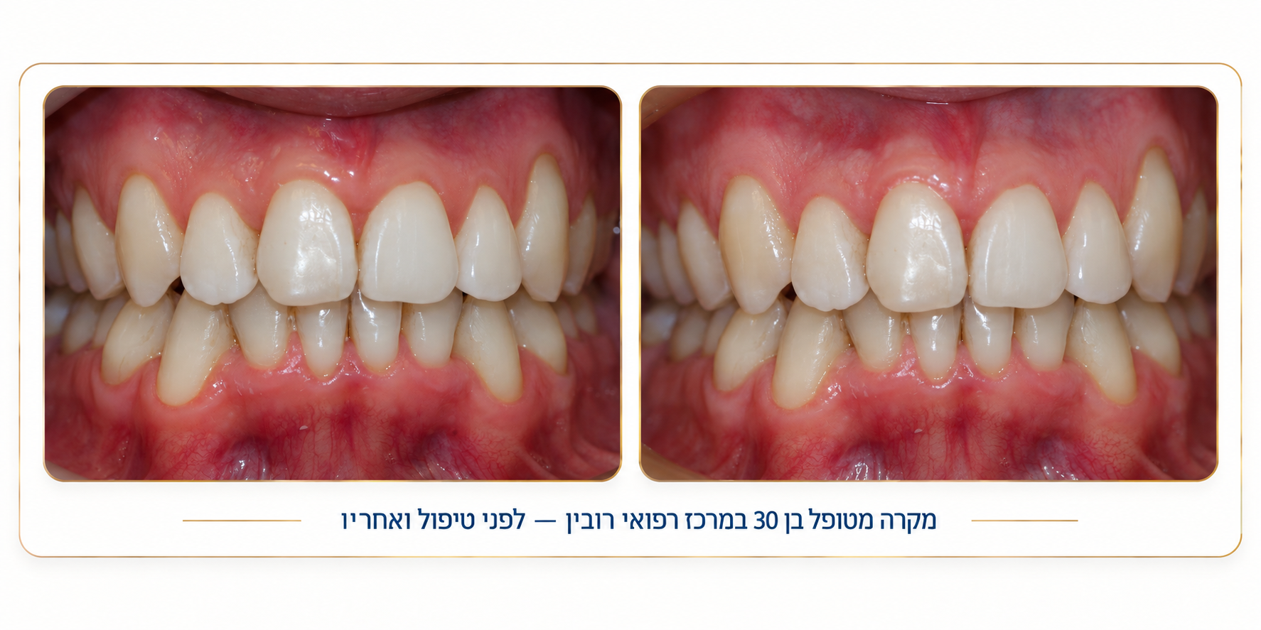 יישור שיניים לפני ואחרי 3 — מקרה מטופל במרכז רפואי רובין