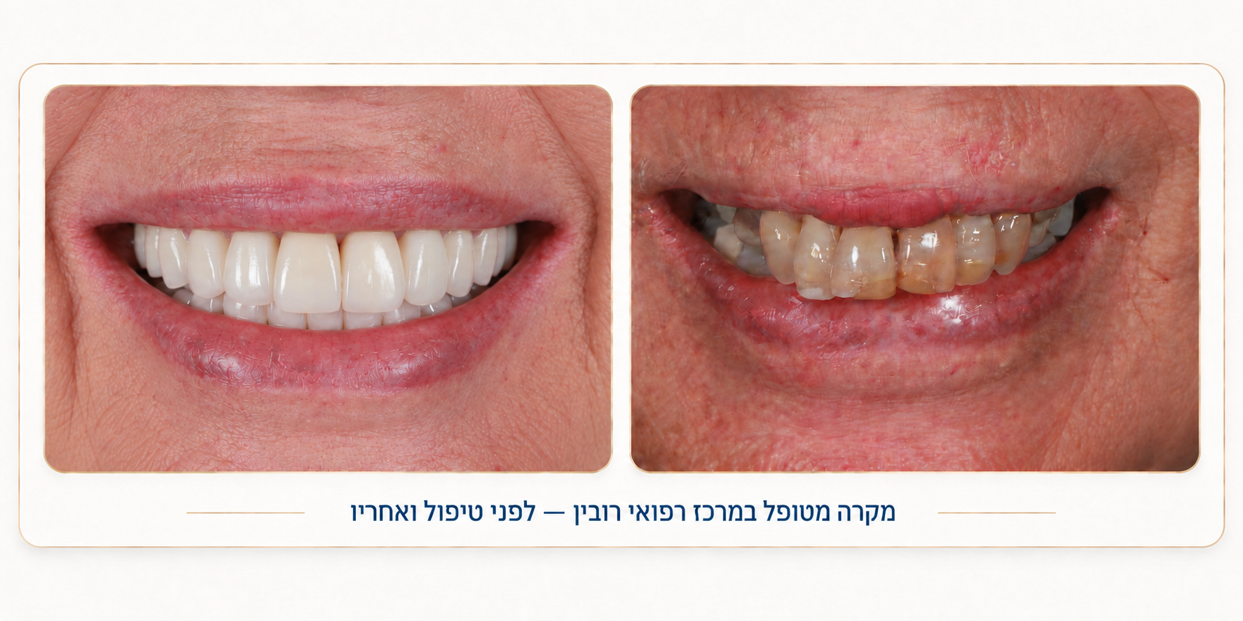 ציפוי חרסינה לשיניים לפני ואחרי – שיקום אסתטי מלא של שחיקת שיניים והלבנה במרכז רפואי רובין