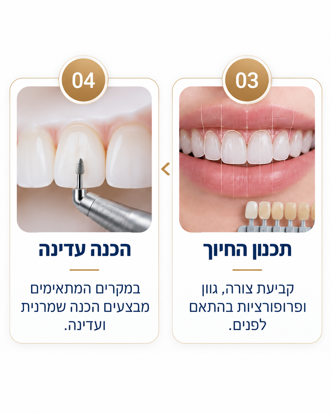 שלבי ציפוי שיניים 03 ו-04: תכנון החיוך לפי צורה וגוון, והכנה שמרנית ועדינה של השן