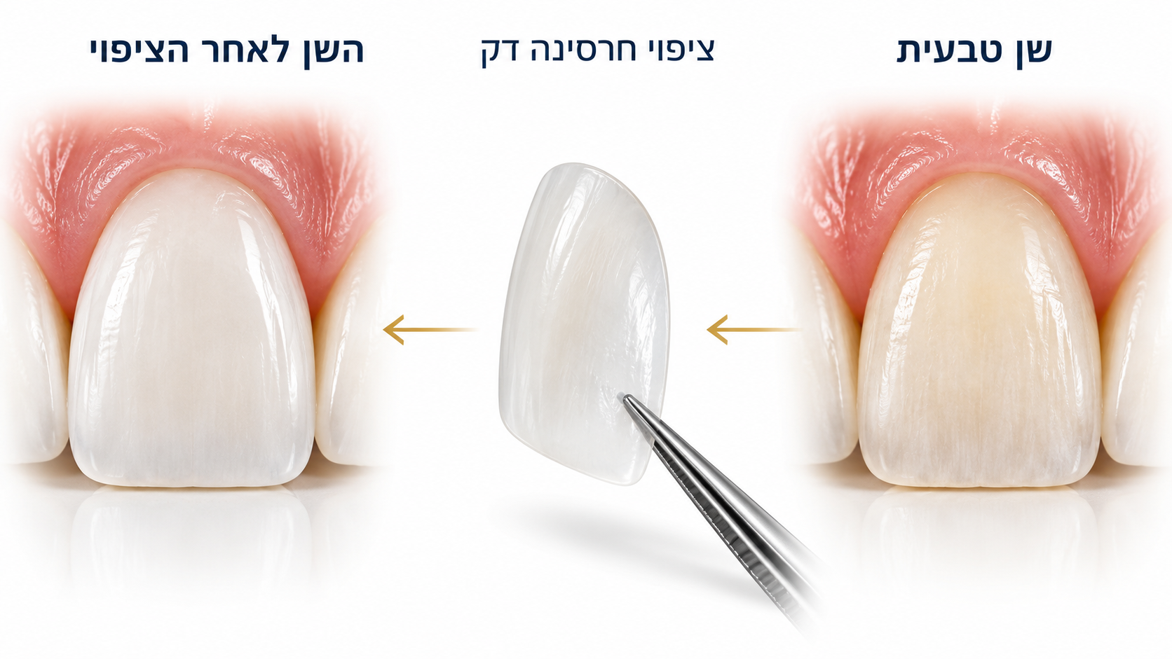 מה זה ציפוי שיניים – ציפוי חרסינה דק המודבק על החלק הקדמי של השן