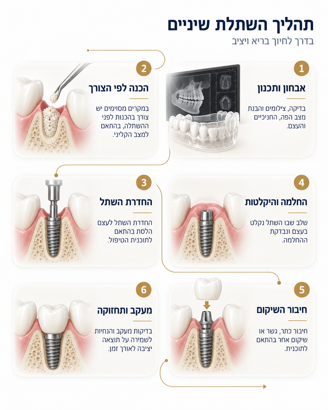 תהליך השתלת שיניים משלב האבחון והתכנון ועד החדרת השתל, ההחלמה, השיקום והמעקב
