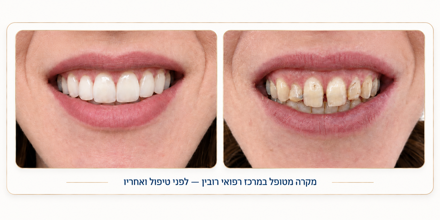 ציפוי חרסינה לשיניים לפני ואחרי – סגירת רווחים ותיקון שחיקה אסתטית בחיוך