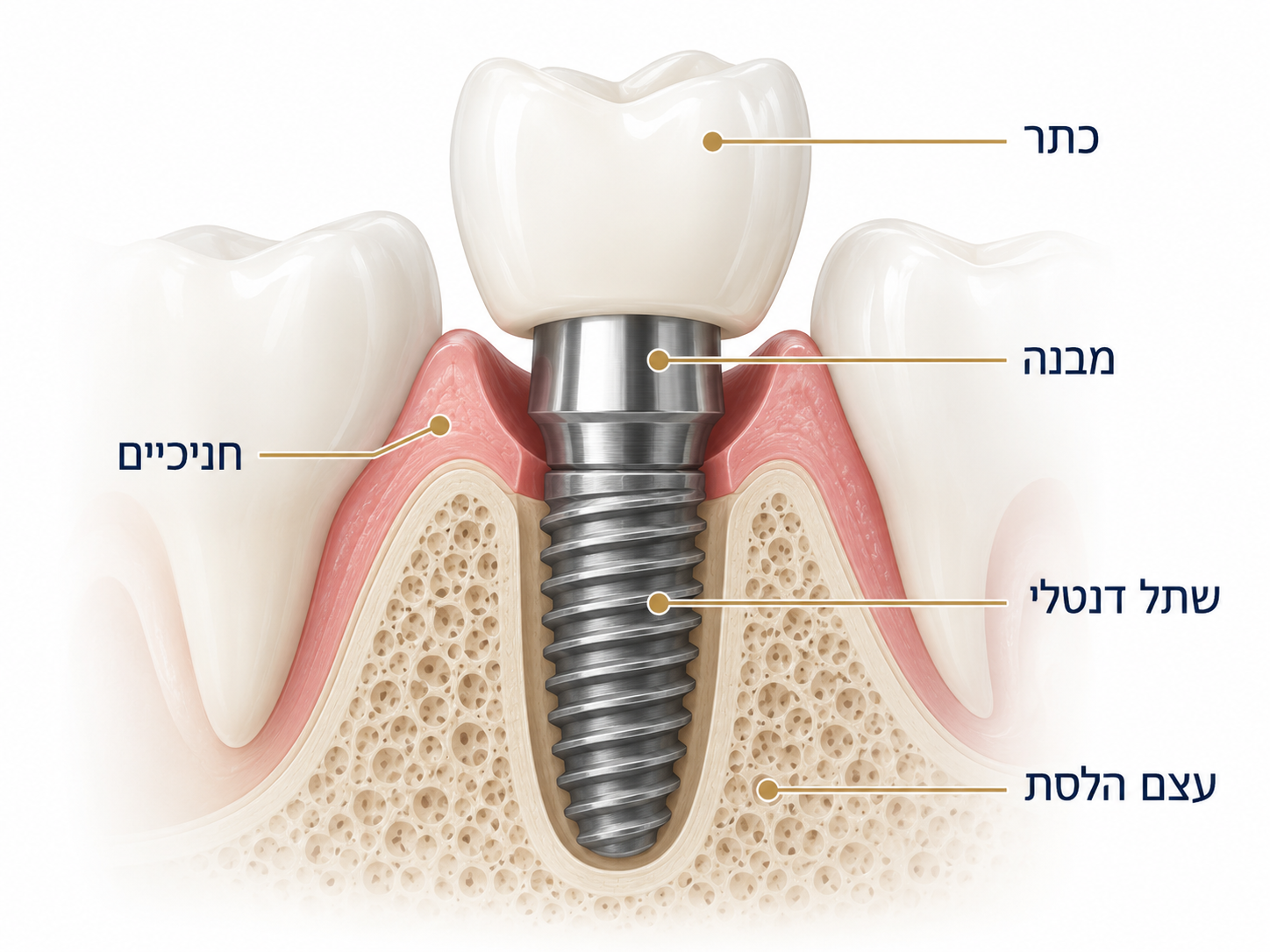 מבנה שתל דנטלי הכולל כתר, מבנה, חניכיים, שתל ועצם הלסת
