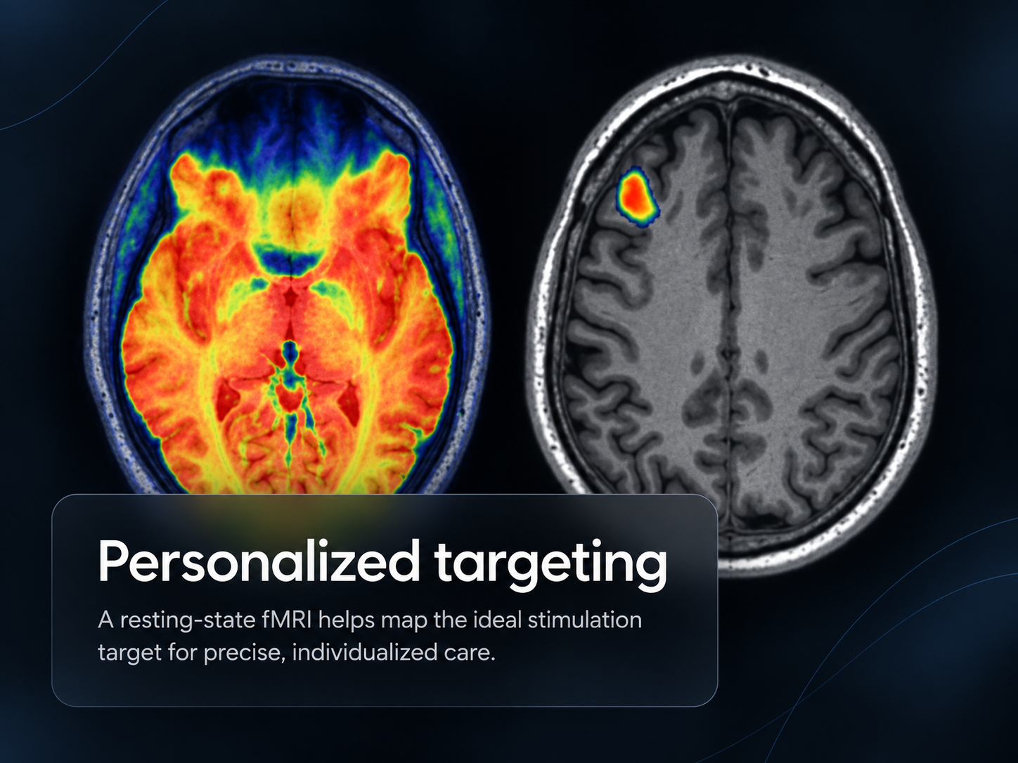 Personalized targeting with resting-state fMRI brain scan for SAINT® TMS therapy