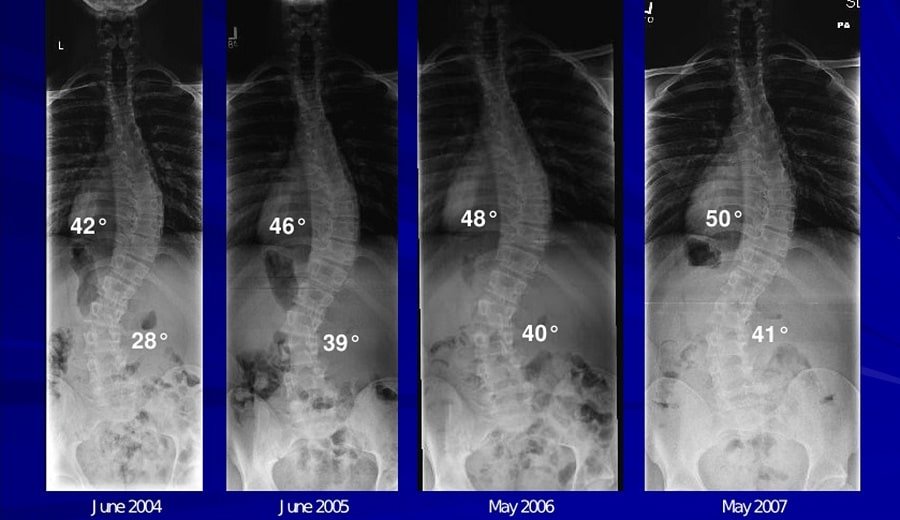 Unraveling the Myth: Does Scoliosis Progress After Growth Stops - Scoliosis article from Lake Nona Chiropractic
